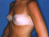 Patient # 16716 Before Photo # 1